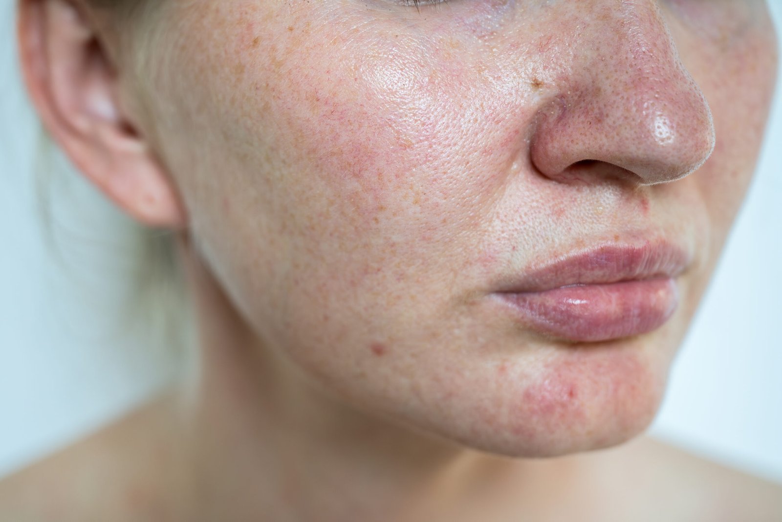 Rosacea