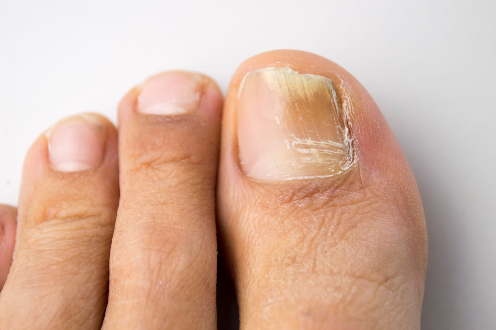 onychomycosis med svampenegleinfektion