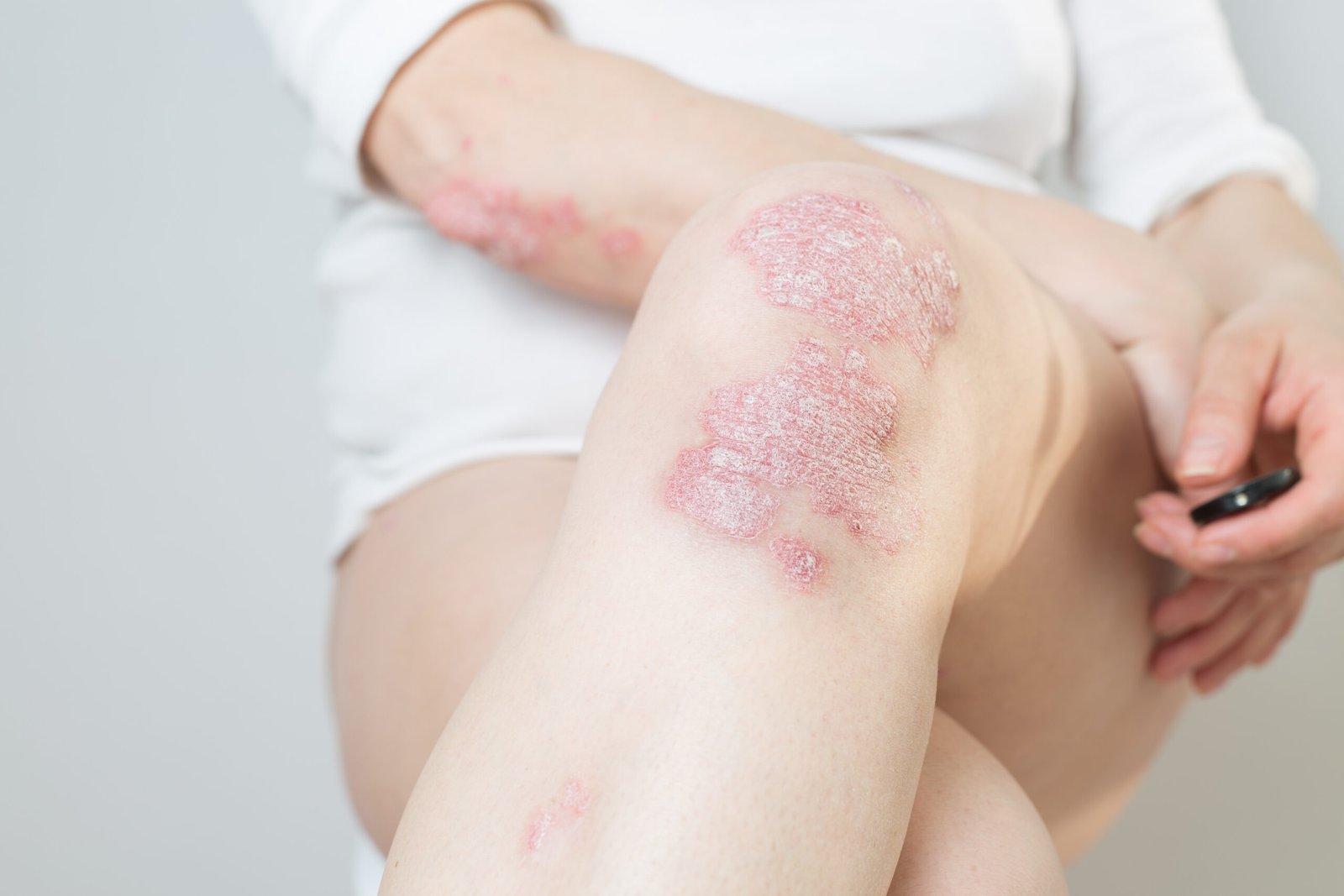 psoriasis på knæ